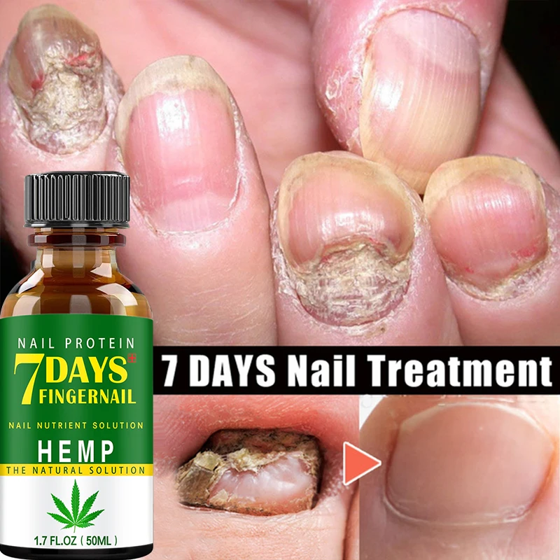 

Nail Fungus Treatment Essence Serum Care Hand and Foot Care Removal Repair Gel Anti-infective Paronychia Onychomycosis
