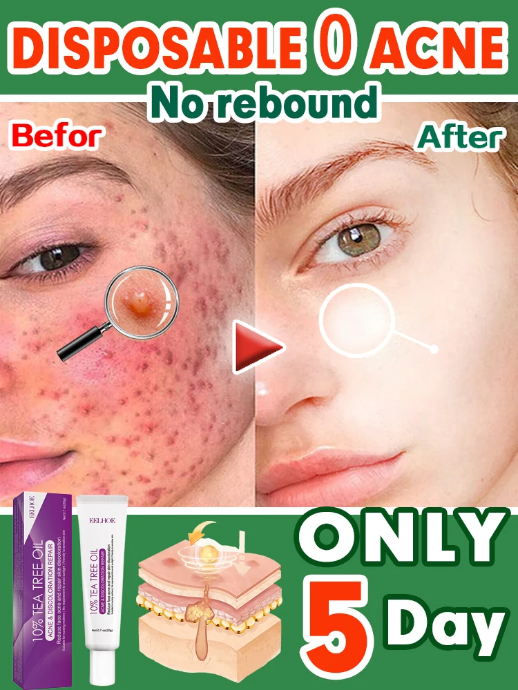 

Tea Tree Acne Treatment Cream Pore Shrink Oil Control Whitening Repair Pimple Deep Cleaning Anti-acne Moisturizer Face Skin Care