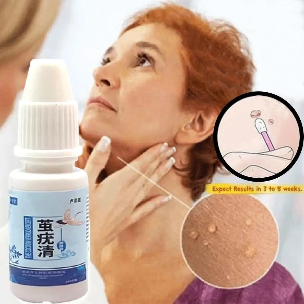 

Skin Wart Treatment Remove Wart Liquid Papilloma From Removal Mole Removal Anti-wart Mole Skin Treatment I8e7