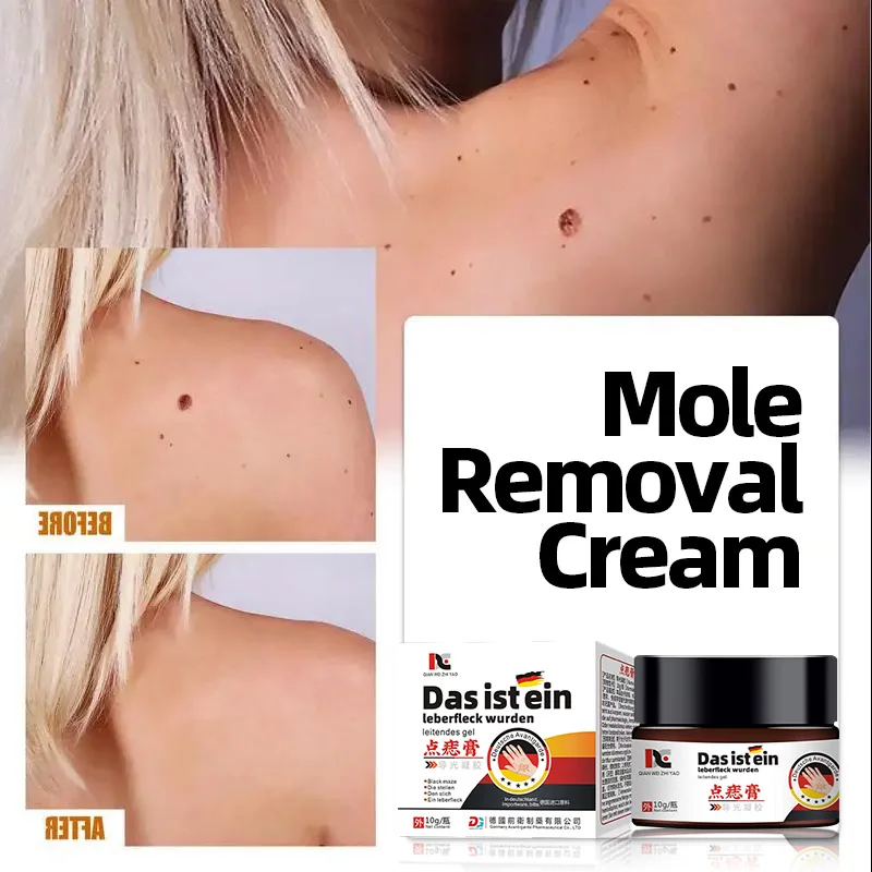 

Skin Tag Moles Remover Treatment Cream Wart Corns Calluses Removal Ointment Dot Nevus Medicine German Secret Recipe