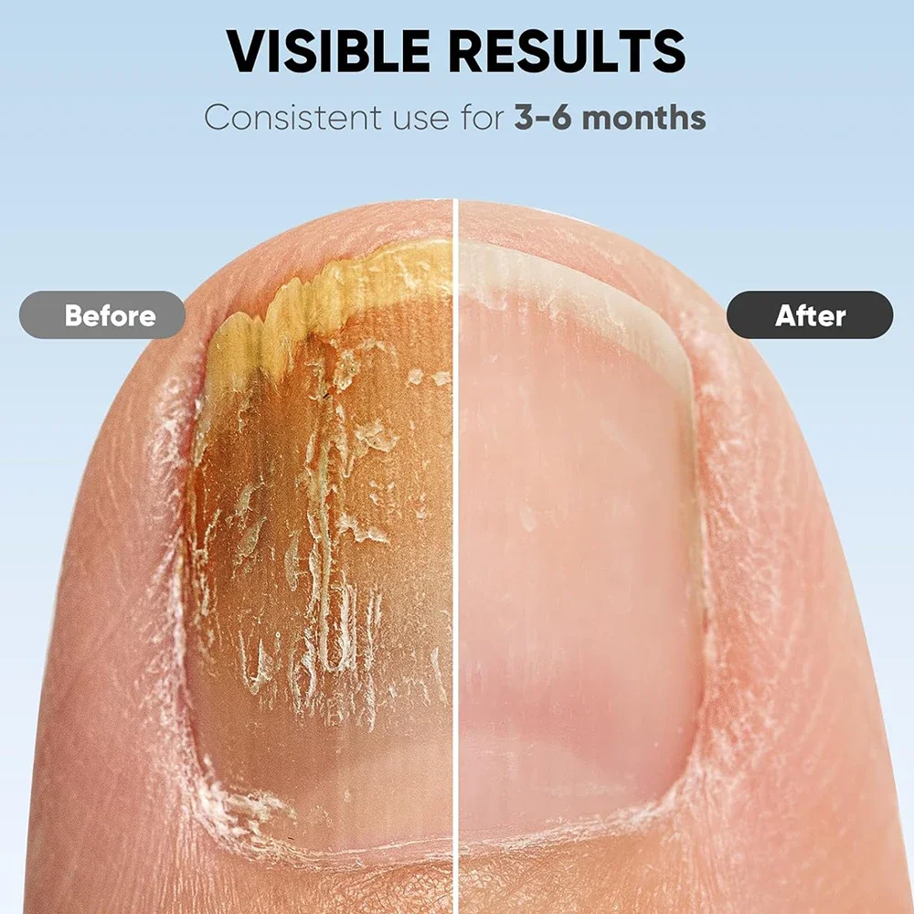 Светодиодный лазерный прибор для лечения грибка ногтей очистки онихомикоза