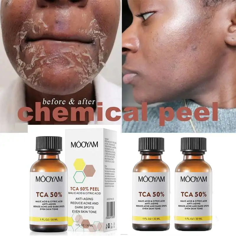 

High Quality TCA 50% Chemical Peel Tca Peel Acid Skin Superforce Peel Pigmentation Lightening Melanin Acne Treatment Remove Scar