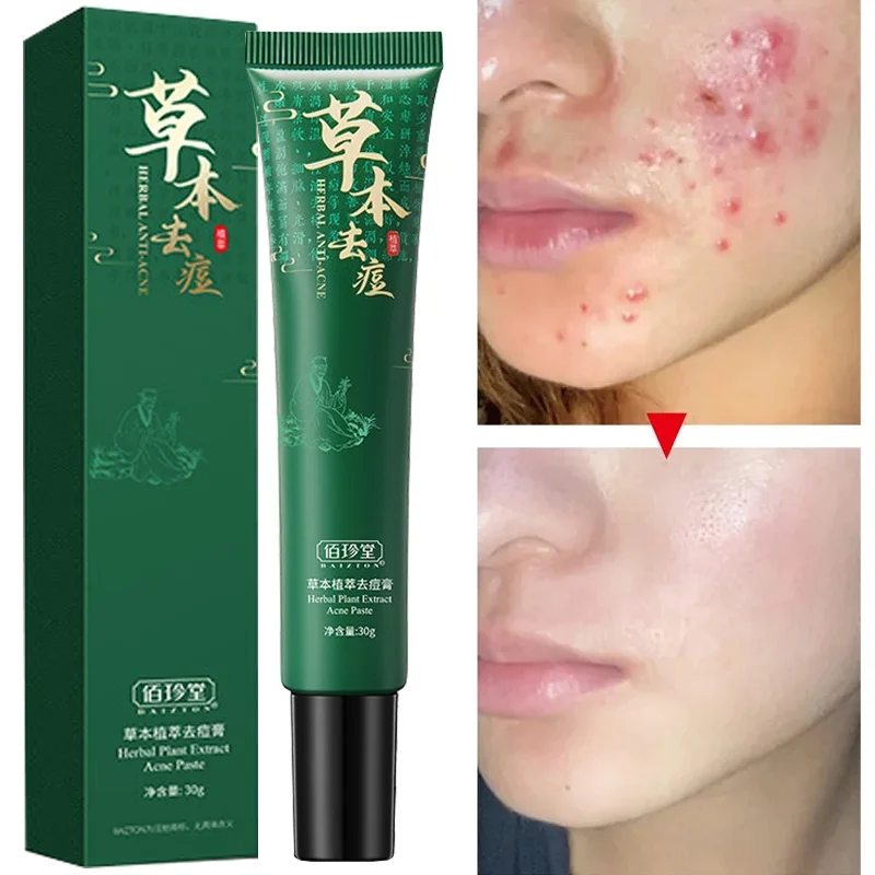 

Herbal Acne Removal Cream Effective Fade Pimple Marks Spots Anti-Acne Control Oil Shrink Pores Whitening Moisturizing Skin Care
