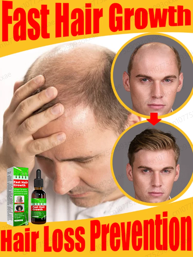 

Hair growth products Fast Hair Growth Hair Growth Oil Effective Baldness Repair Hereditary Hair Loss Seborrheic Hair Anti Loss