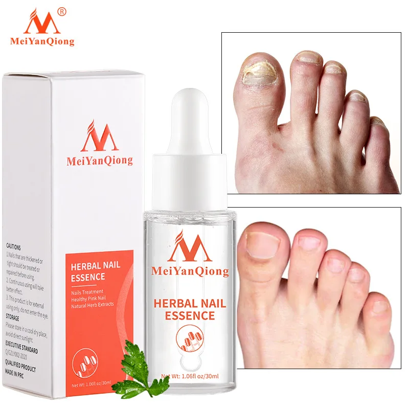 

Nail Treatment Feet Care Essence Nail Foot Whitening Toe Nail Fungus Removal Gel Anti Infection Paronychia Onychomycosis