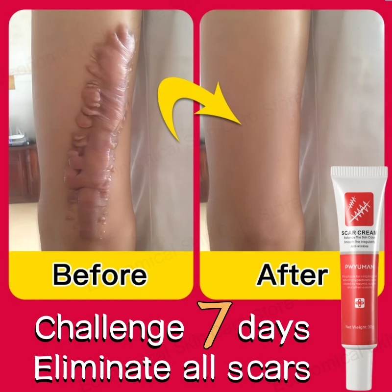 

Recovery Scar Cream Fast Remove Deep Skin Scar Acne Stretch Marks Burn Keloid Spot Treat Gel Herbal Smooth Whiten Face Skin Care