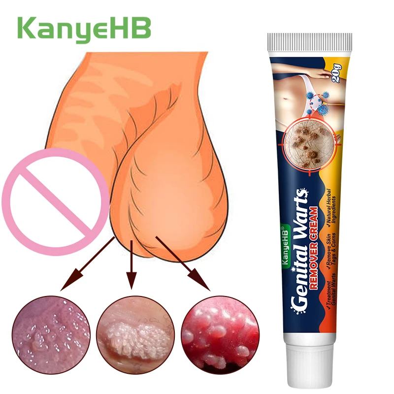 

1Pcs Wart Treatment Cream Private Parts Genital Wart Skin Tags Papillomas Condyloma Acuminatum Remover Herbal Medical Cream G046