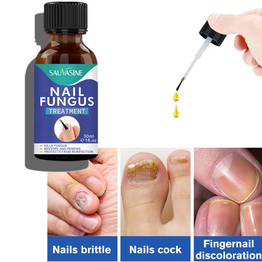 

30ml Fungal Nail Repair Essence Serum Care Treatment Foot Nail Fungus Removal Gel Anti Infection Paronychia Onychomycosis Care