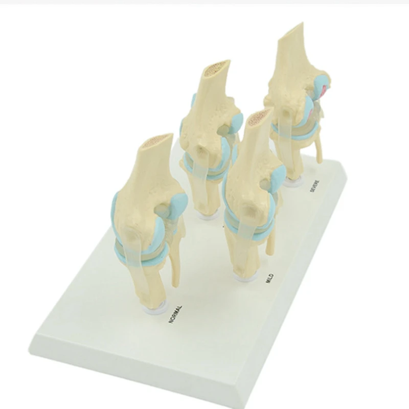 Анатомические человеческие дегенеративные наколенные суставы рандомные