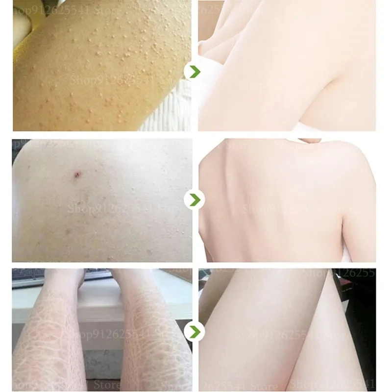 50 г крем для волосяного фолликула и кератоза восстанавливает кожу