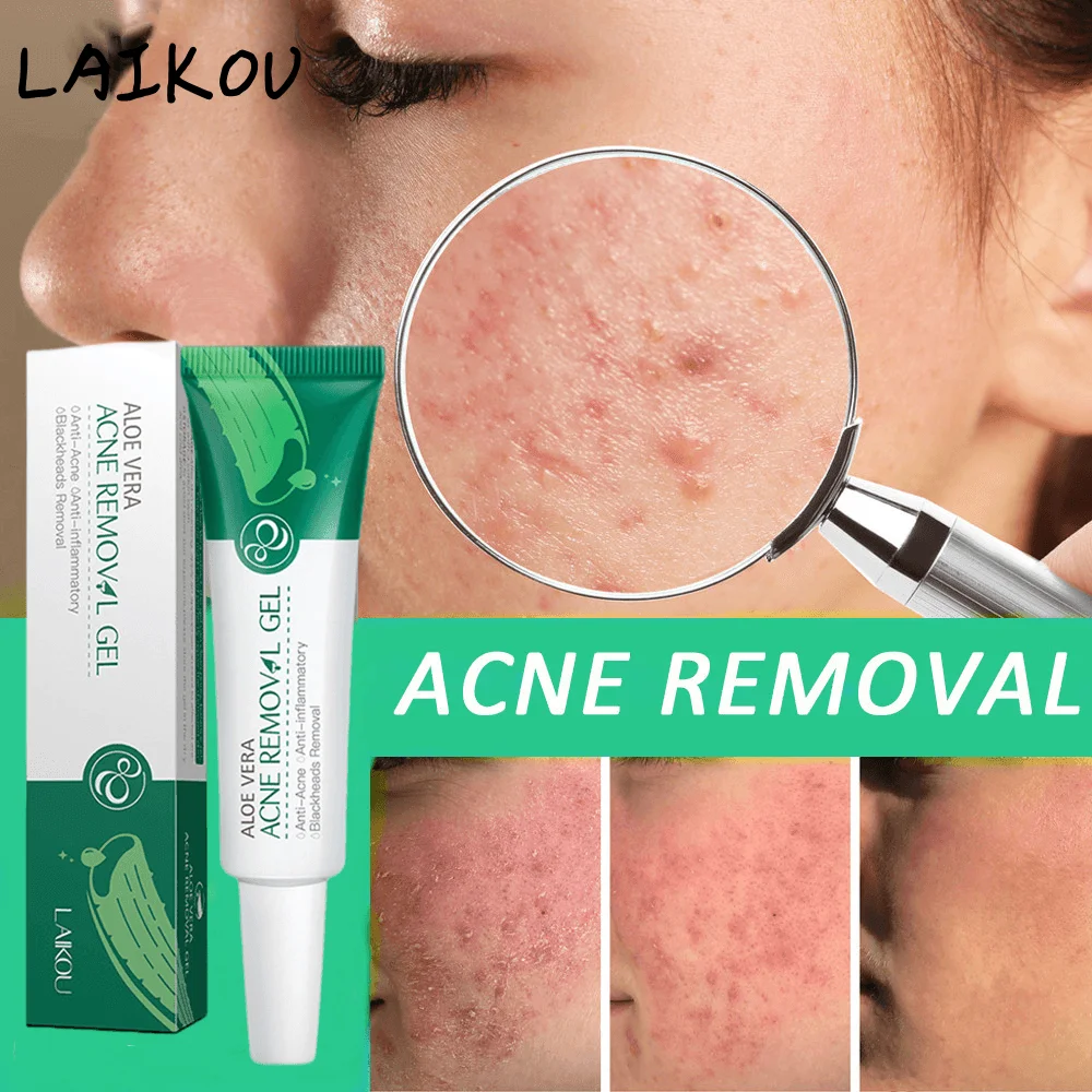 Aloe Vera Acne Removal Gel Cream Anti-acne Treatment Acne Scar Shrink Pores Oil Control Acnes Pimples Whiten Herb Skin Care 20g