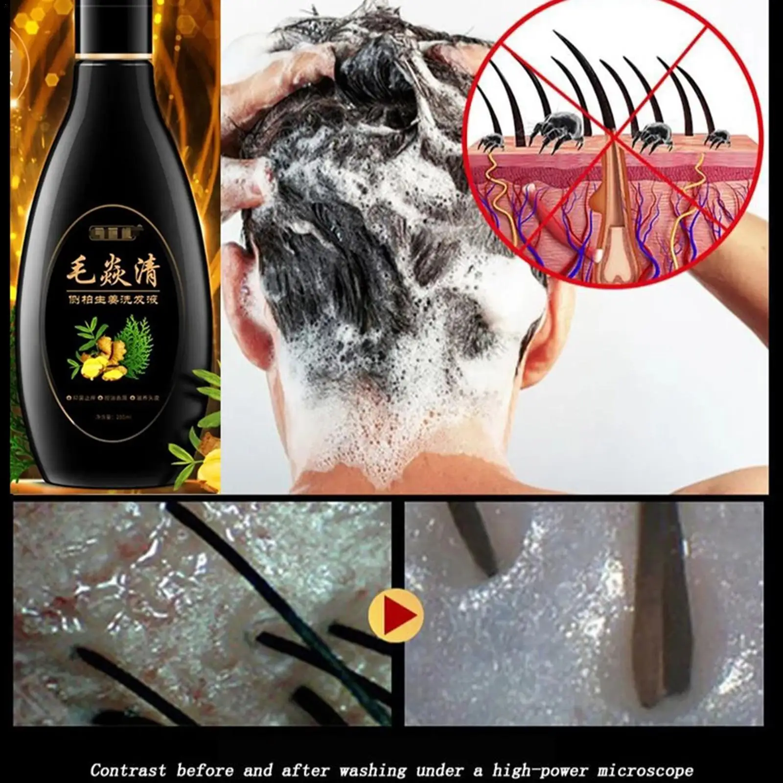 200ml Hair Psoriasis Seborrheic Skin Care Treatment Shampoo Eczema Hair Compound Dermatitis Reverse Cleansing Herbal Hair O0T9