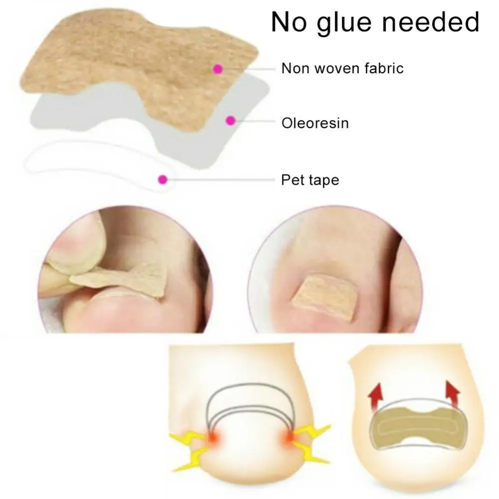 

Sticker 50Pcs Ingrown Toe Nail Correction Paronychia Foot Pedicure Corrector