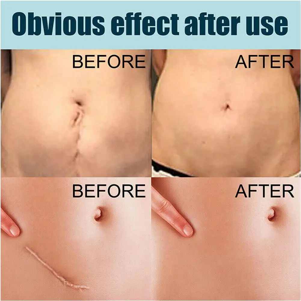 Рисунок 4 - Средство для удаления рубцов после акне