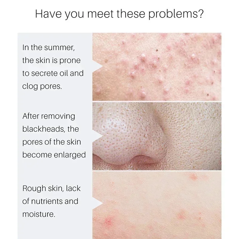 Удаление большого поры Сыворотка с молочной кислотой сужение пор на лице