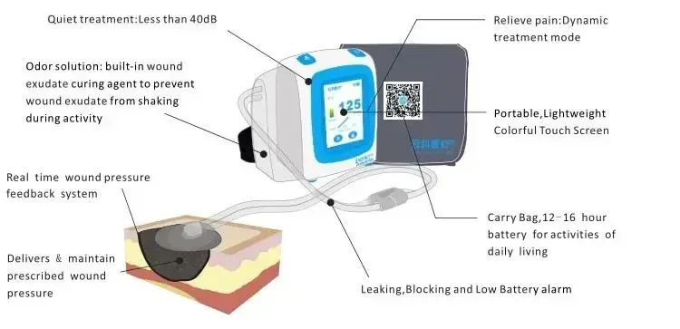 Аппарат для терапии ран отрицательного давления с дренажной канистрой 140 мл/450 мл