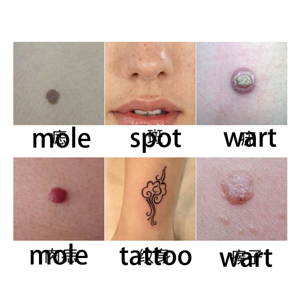 Лазерная плазменная ручка машина для удаления веснушек ЖК-дисплей удаление