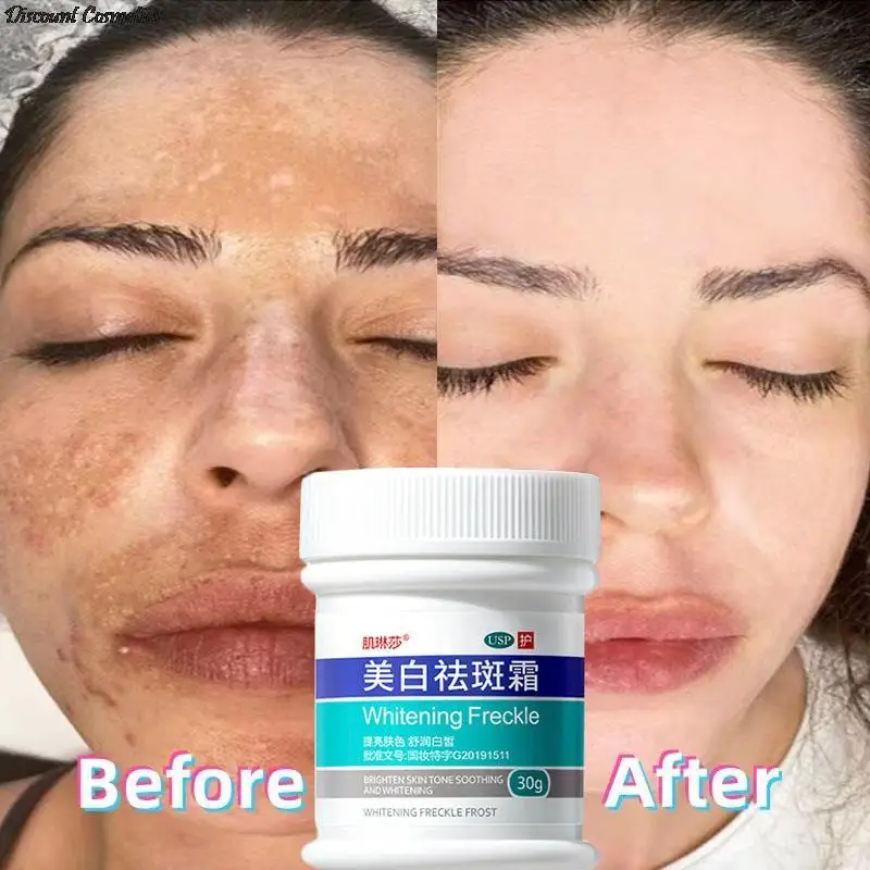 

Whitening Freckle Cream Dark Spot Corrector Cream Lighten Pigmentation Improve Dull Skin Remove Melasma 30g