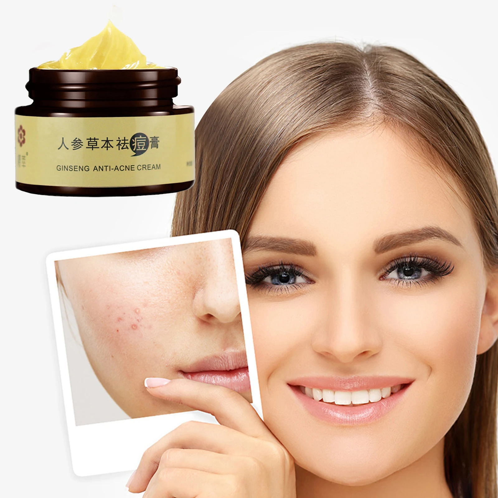 

Herbal Repair Acne Removal Cream Anti Pimple Acne Treatment Fade Spots Oil Control Shrink Pores Whitening Moisturizing Skin Care