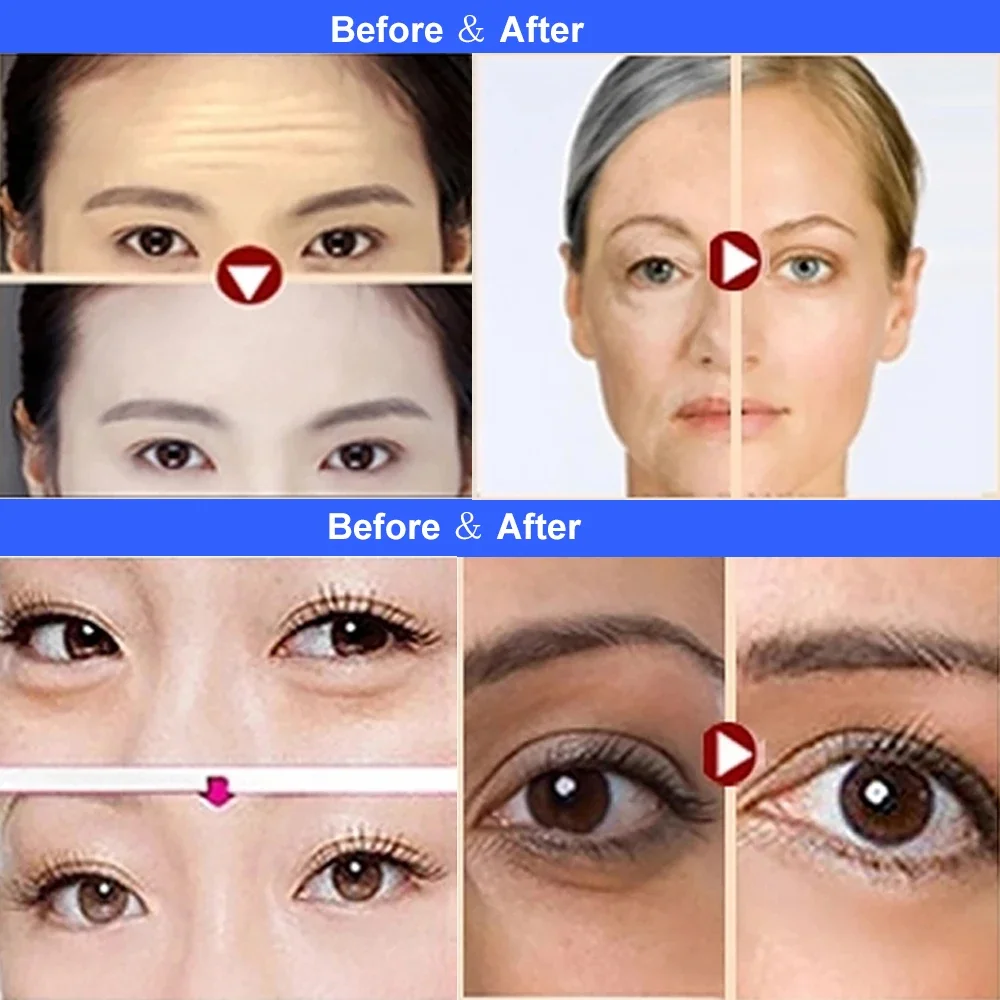 AOKO radie Частотная монополярная машина для похудения лифтинг лица удаление морщин