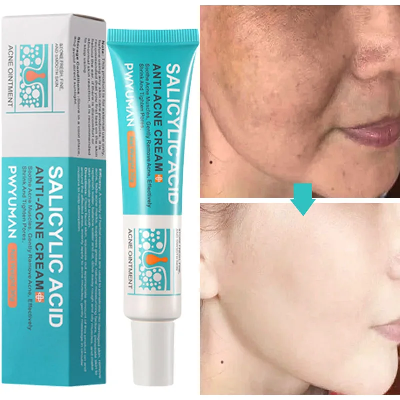 

Salicylic Acid Exquisite Whitening Face Cream Facial Acne Treatment Hyaluronic Acid Black Dots Removal Skin Care Beauty Health