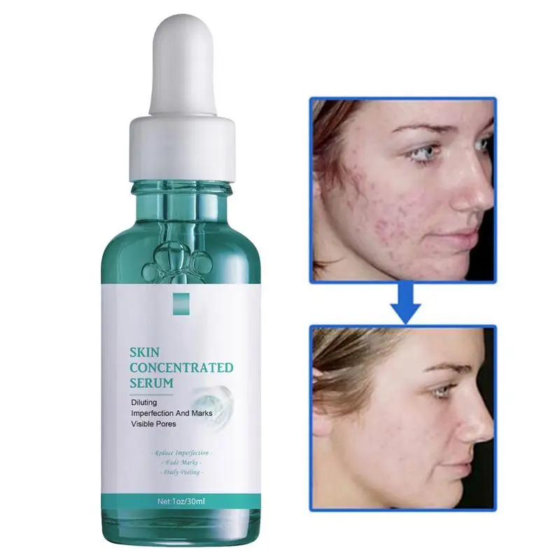 

30ml Exfoliating Moisturizing Nourish Smooth Pores Repair Essence Repairing Pimple Skincare Oil Control Hydrating Face Essence
