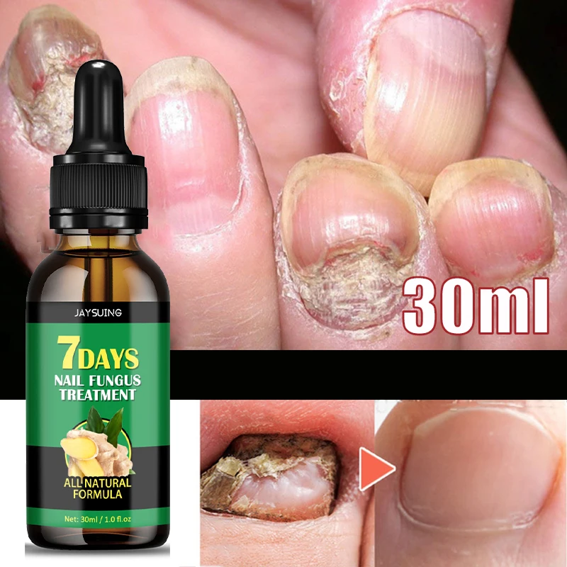 

7 Days Ginger Nail Fungal Treatment Feet Care Essence Anti Infection Paronychia Onychomycosis Foot Toe Nail Fungus Removal Gel M