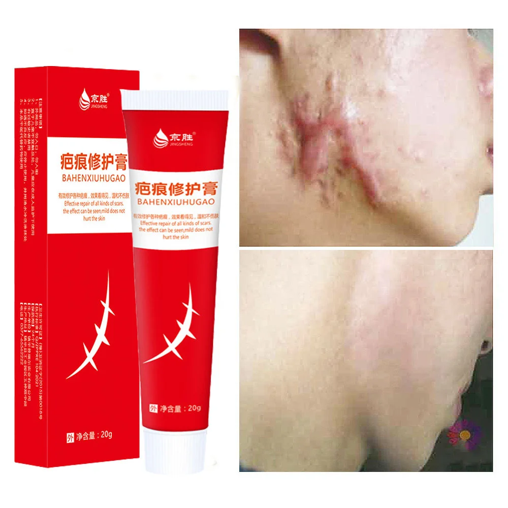 

20g Acne Scar Removal Cream Stretch Marks Fade Scald Burn Surgical Scars Acne Spots Treatment Smooth Whiten Repair Gel Skin Care