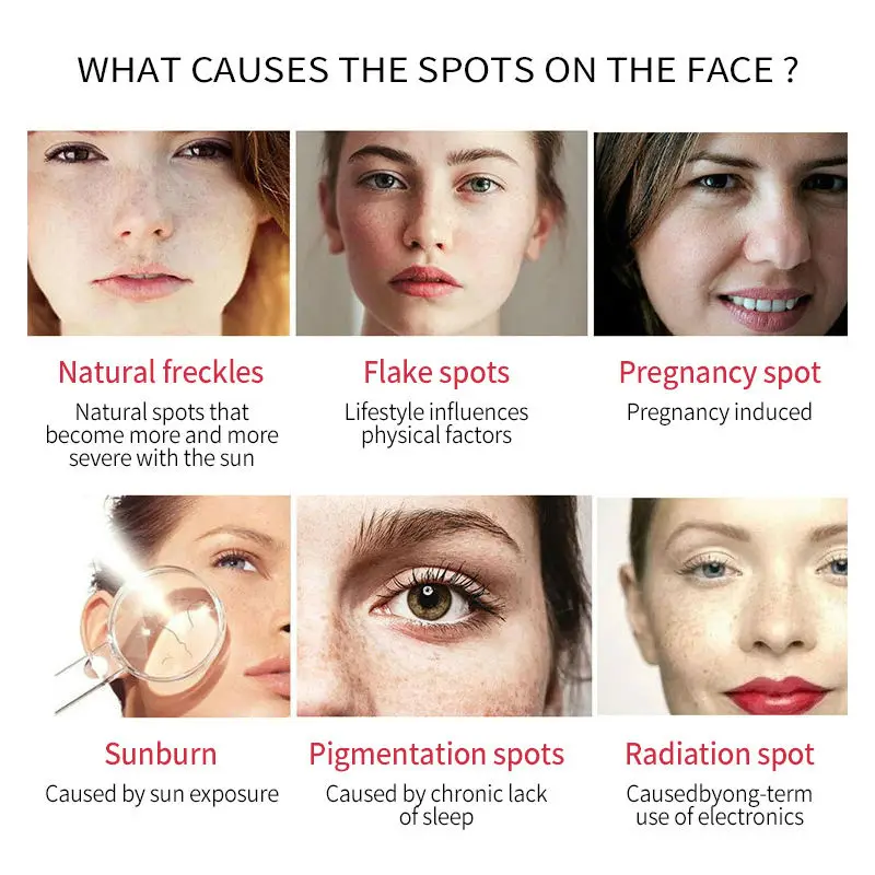 Отбеливающий крем Dimollaure для лица удаления веснушек пятен мелазмы солнечных