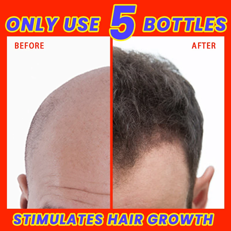 

Масло для роста волос, эффективное средство для быстрого роста волос, восстановление облысения, выпадение волос, после родов, потеря волос, себорреевое