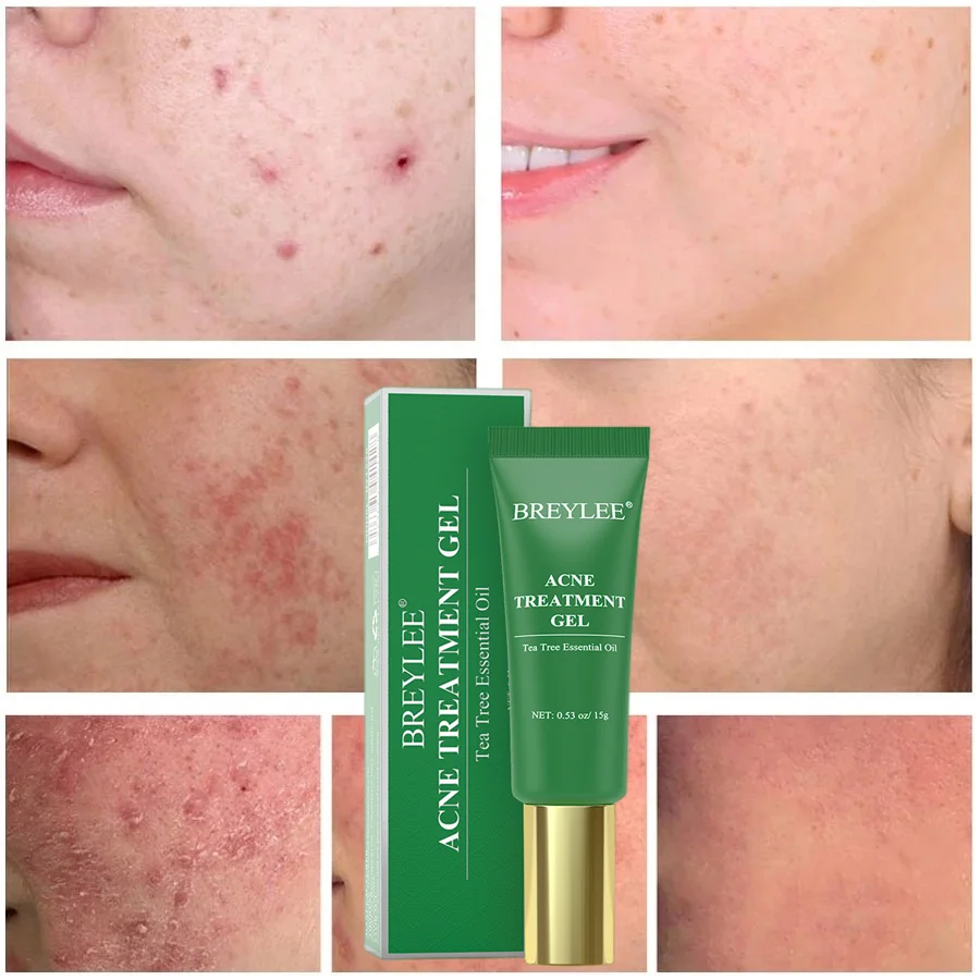 

Tea Tree Salicylic Acid Acne Removal Face Serum Effective Treatment Pimple Marks Gel Shrink Pores Removal Spots Acne Scar Cream