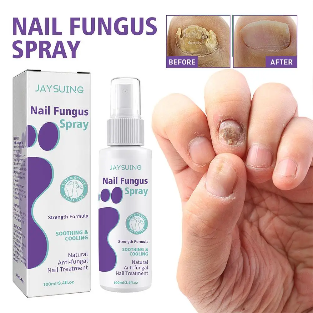 

Effective Anti-Fungal Feet Infections Athlete Foot Nail Fungus Hand And Foot Care Treatment Spray Beauty Health Care 100ml