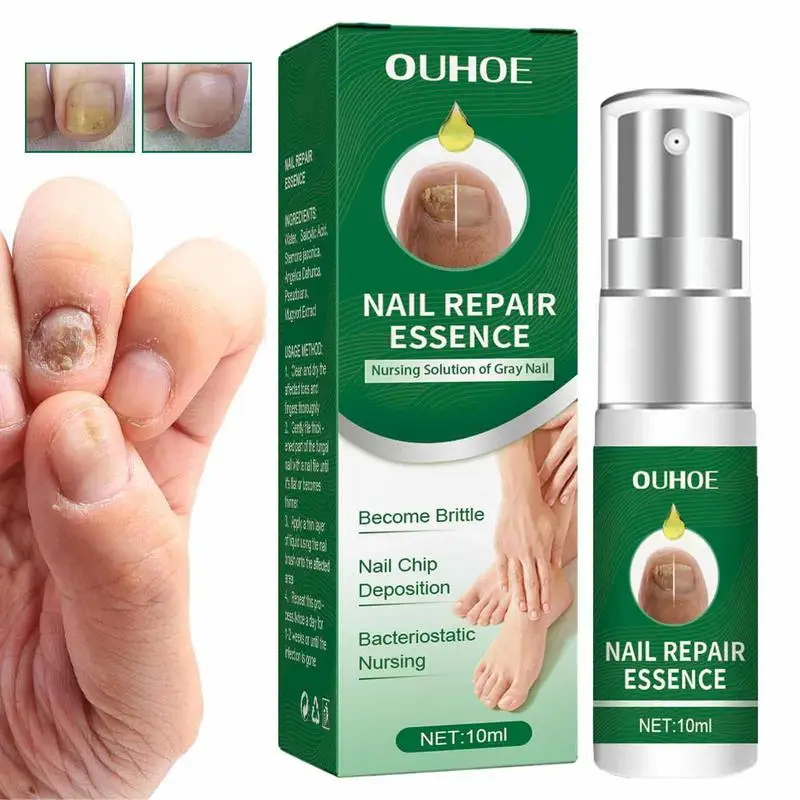 

Эссенция для восстановления ногтей, масло для восстановления ногтей при повреждении ногтей, обесцвеченные лекарства для ног и ног, восстановление ногтей, уход за ногами для рук, 10 мл