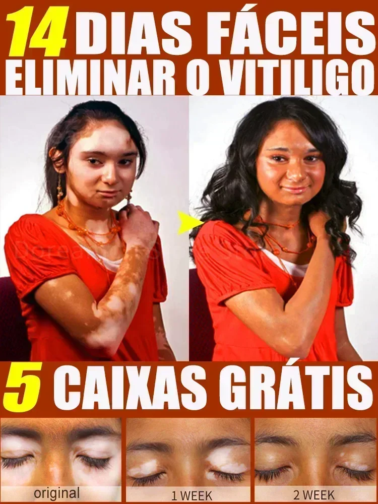 Крем Vitiligo улучшает белое пятно xxx