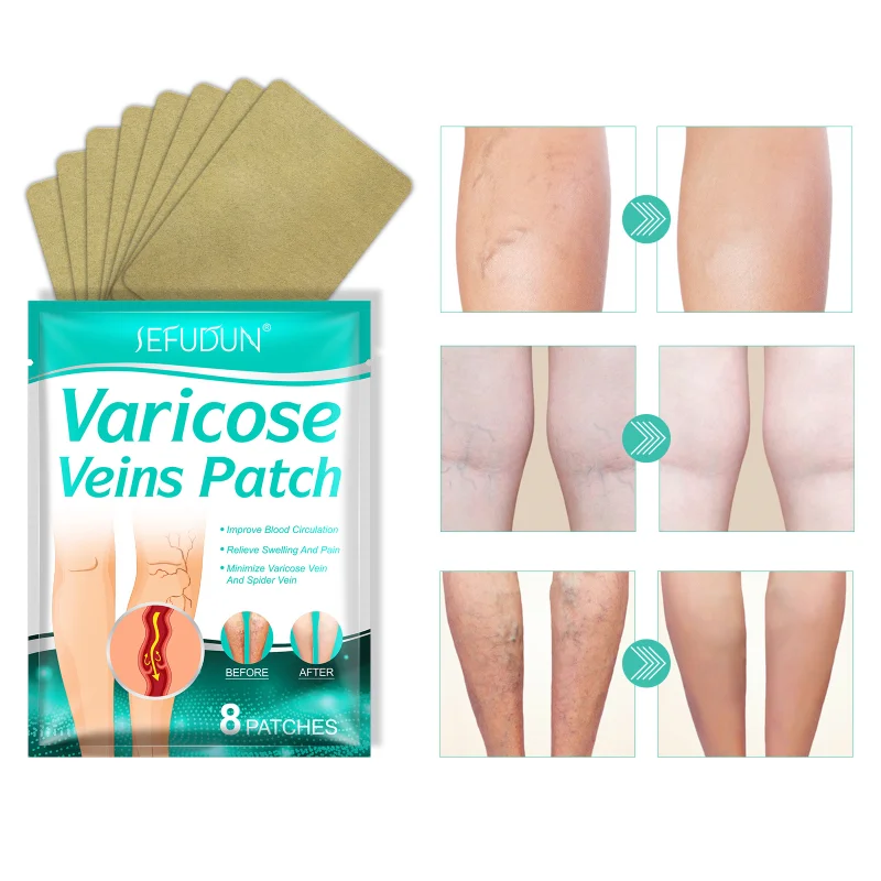 

Varicose Veins Patch Varicose Veins Treatment Blood Vessel Swelling Spider Leg Vasculitis Phlebitis Care Angiitis Plaster Patch