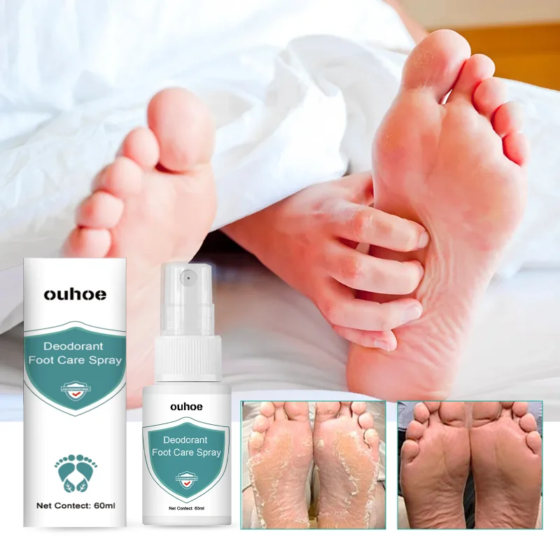 

Спрей для ног от бербериби, средство для удаления сильного запаха от грибков, снимает сухое пилинг, дезодорант от зуда, псориаза, тинея, увлажняет уход за ногами