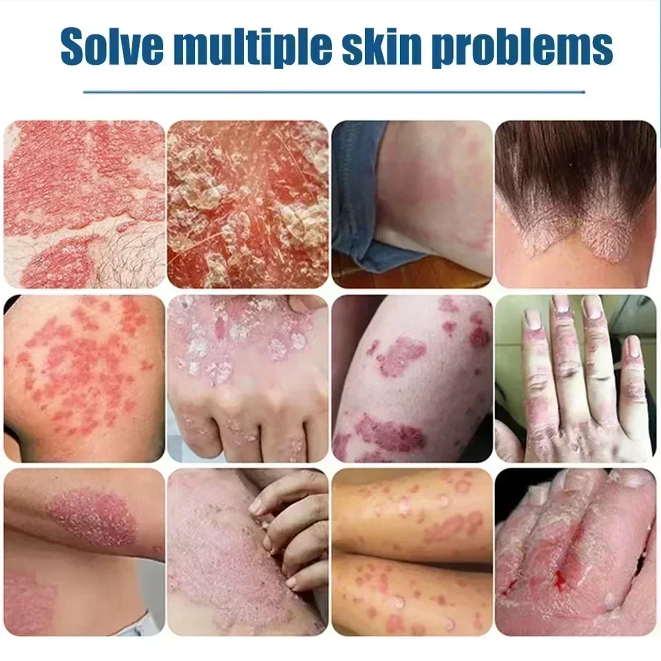 Самый эффективный здоровый дневной крем натуральный травяной антибактериальный