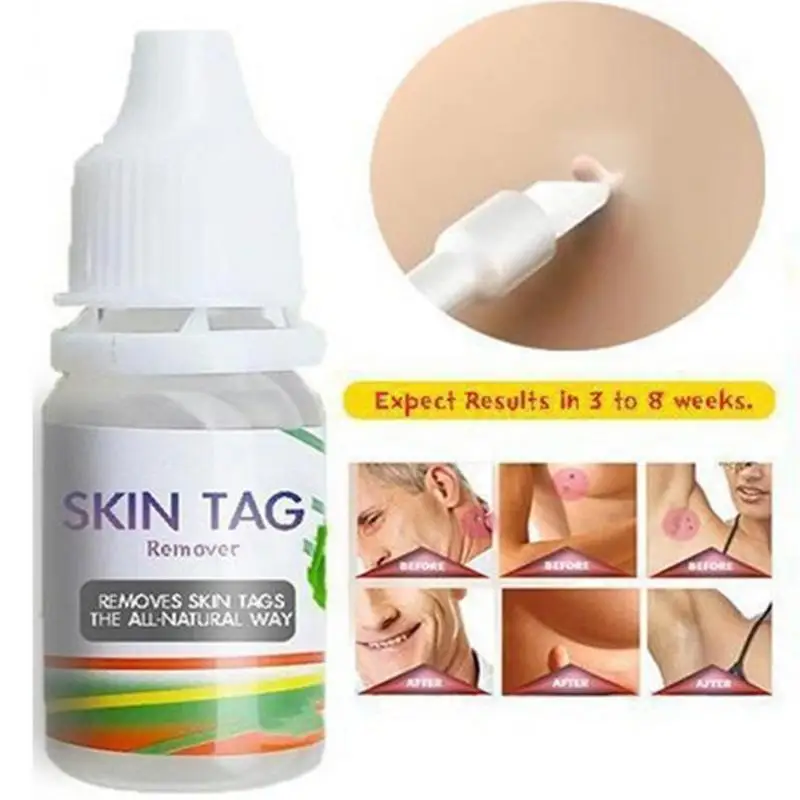 

Liquid Skin Tag Remover Warts Clearing Corn Plaster Liquid Non-Irritating Removes Skin Tags Plantar Warts Skin Tags Corns