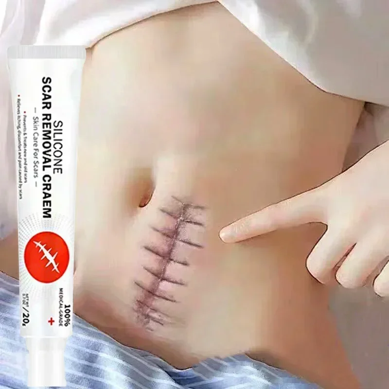 Крем для удаления шрамов средство лечения растяжек сглаживание отбеливание уход