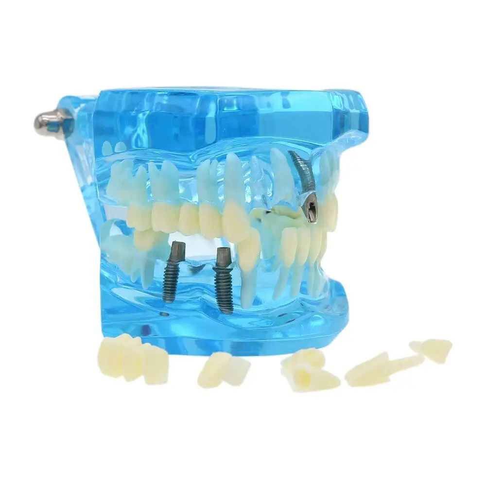 

Dental Implant Teeth Model Teach Study Bridge Restoration Pathology Typodont Teeth Model M2001 Blue