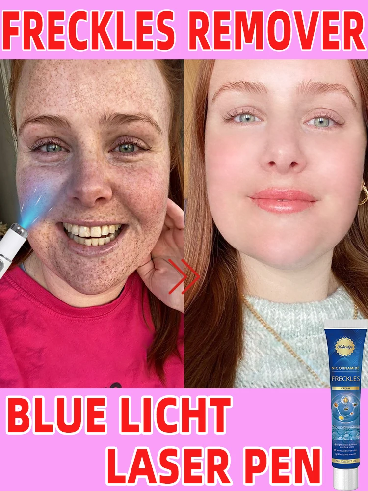 Лазерные веснушки темные пятна от солнца