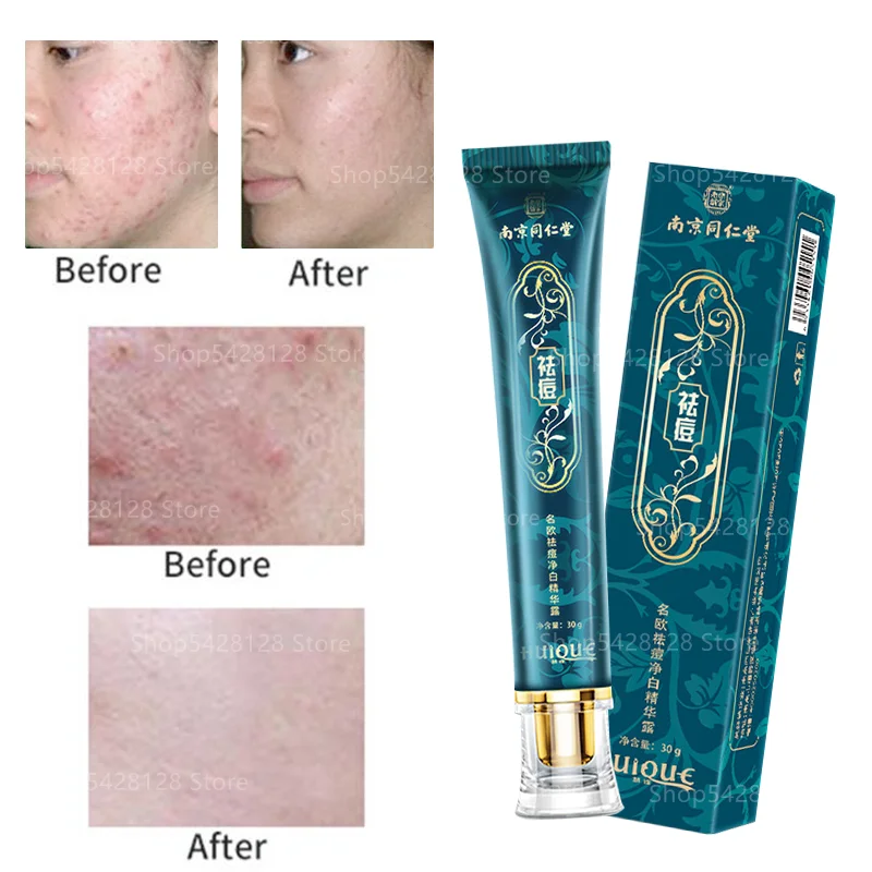 

Acne Cream To Remove Acne Scars, Whitening Essence, Herbal Acne Cream, Facial Care, Acne Marks and Spots Removal Facial