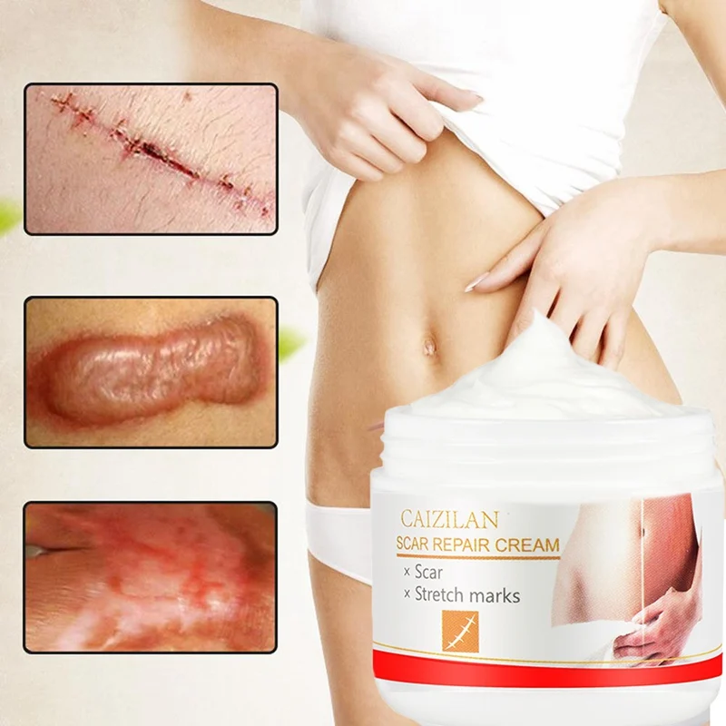 30g Body Stretch Mark Removal Creams Pregnancy Scar Obesity Pattern Promote Cell Regeneration Repair Enhance Skin Elasticity |
