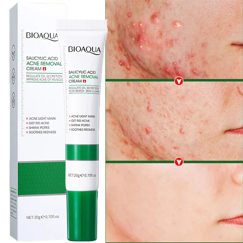 Herbal Acne Treatment Cream Fade Acne Scar Spots Oil Control Gel Improve Roughness Shrink Pores Moisturizing Facial Skin Care