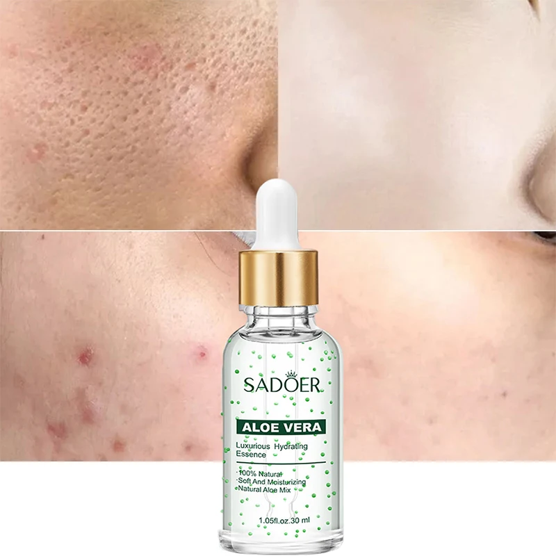 

Aloe Vera Acne Removal Serum Treatment Pimple Essence Shrink Pore Remove Blackheads Fade Acne Marks Moisturizer Brightening Care