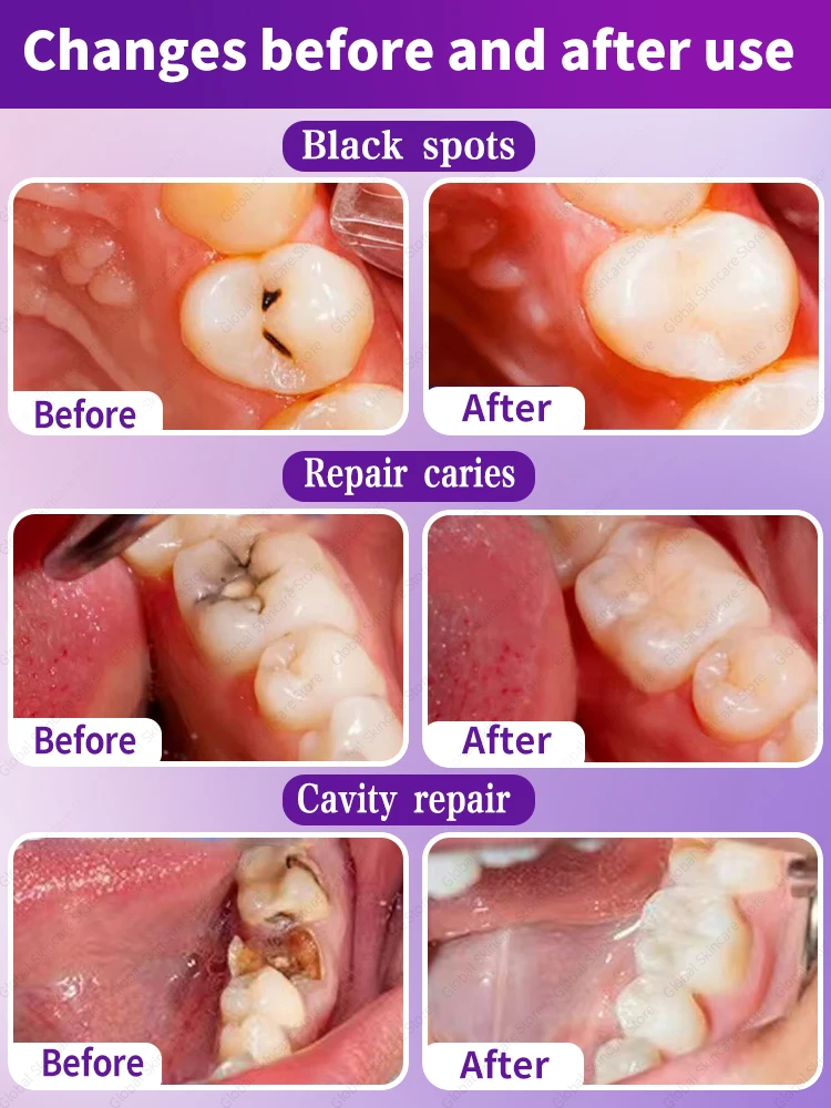 tooh Decay ремонт