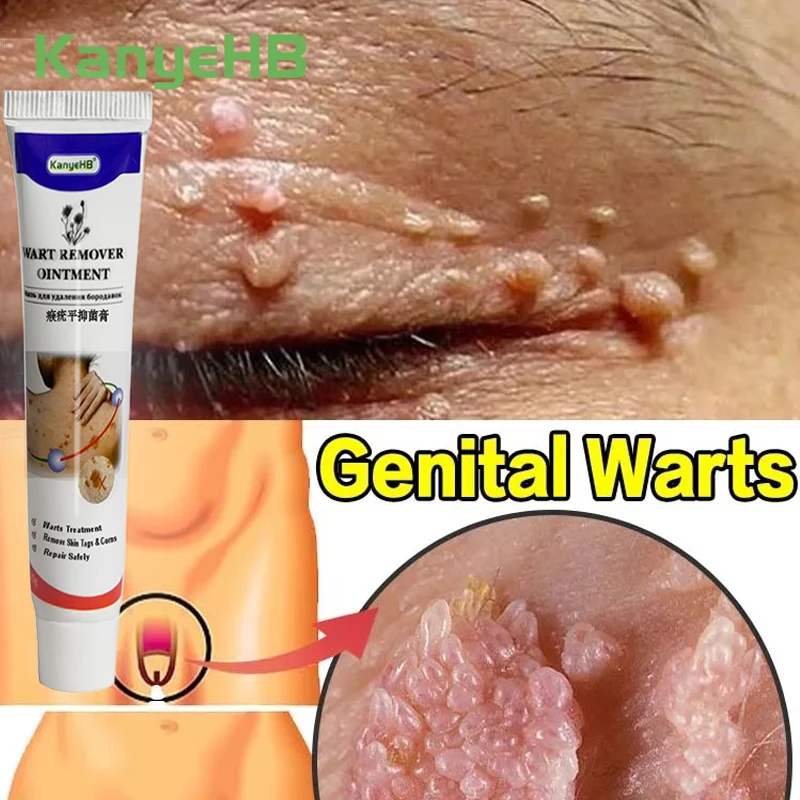 

1 шт., медицинский крем для удаления бородавок