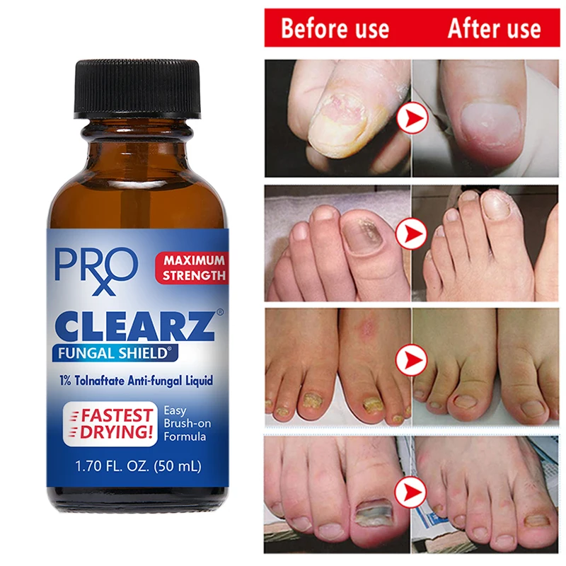 

Onychomycosis Treatment-Nail Repair Essential Oil, Quickly Remove Fungus, Remove Onychomycosis,Paronychia, Prevent Onychomycosis