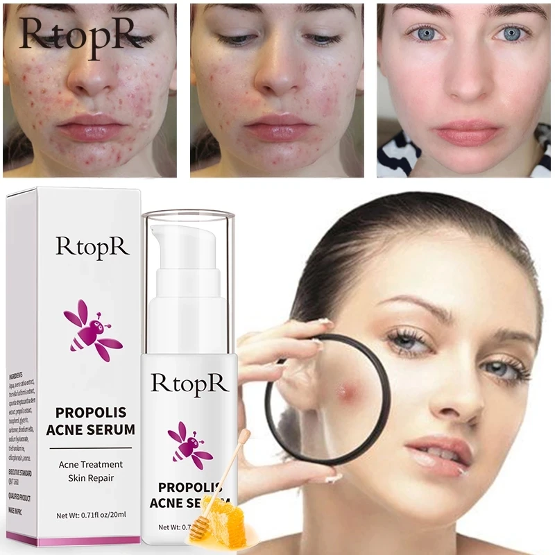 Средство для лечения акне с прополисом 20 мл