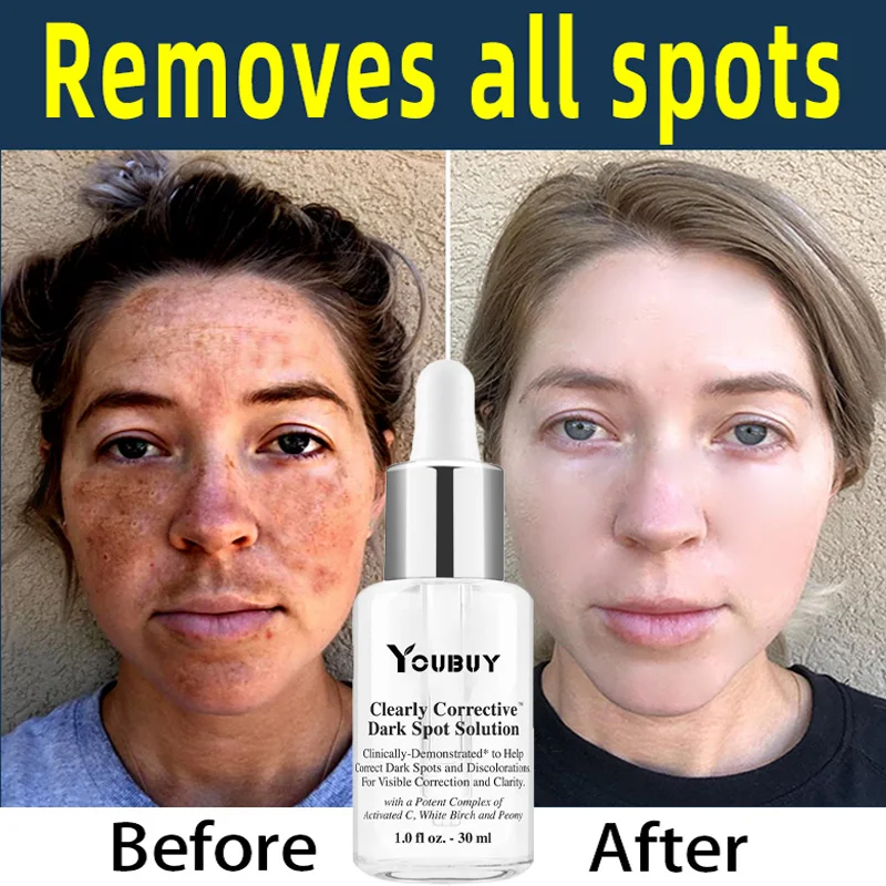 

Powerful Whitening Freckle Serum Remove Dark Spots Melasma Brighten Lighten Melanin Improve Dull Anti-aging Face Skin Care 30ml